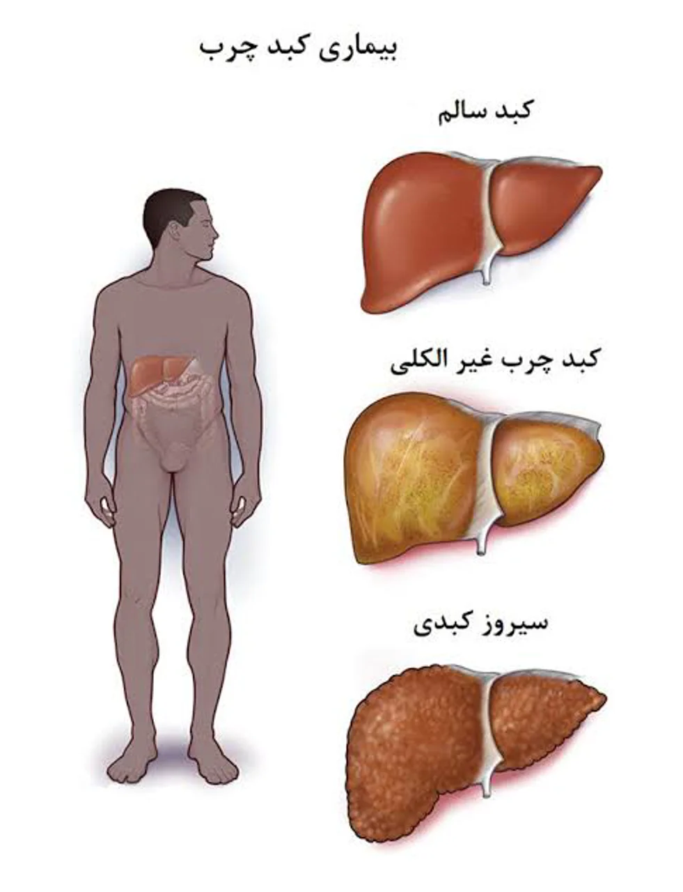 کبد چرب؛ قاتل خاموشی که در دنیای مدرن به مهمان ناخوانده‌ی ما تبدیل شده است!